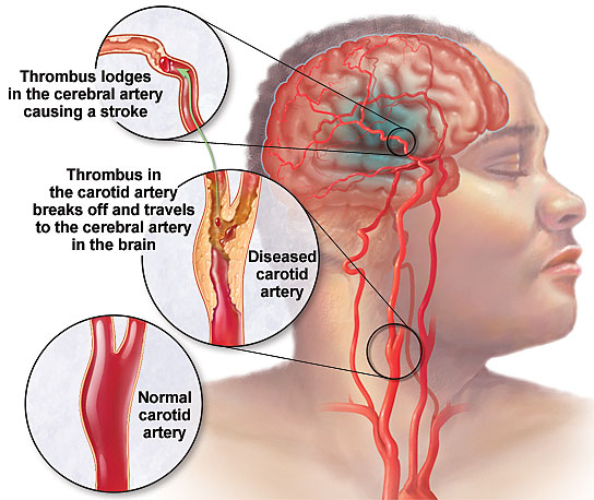 What are some side effects of a TIA stroke?